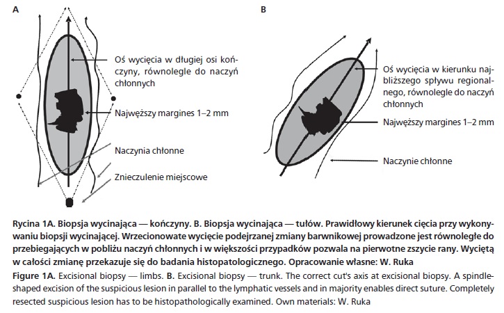 czerniak skry - biopsja wycinajca